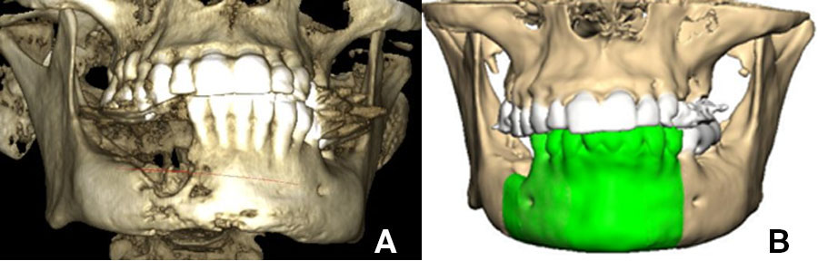 The particulate iliac crest bone graft: An overlooked alternative for mandibular reconstruction