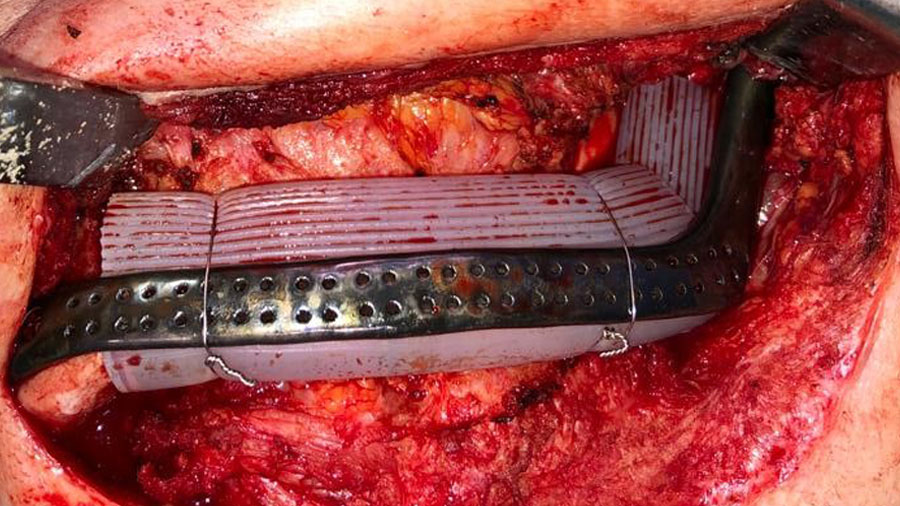 The particulate iliac crest bone graft: An overlooked alternative for mandibular reconstruction