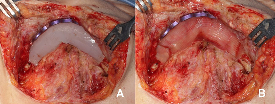 The particulate iliac crest bone graft: An overlooked alternative for mandibular reconstruction