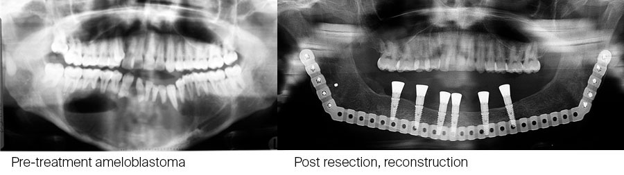 The particulate iliac crest bone graft: An overlooked alternative for mandibular reconstruction