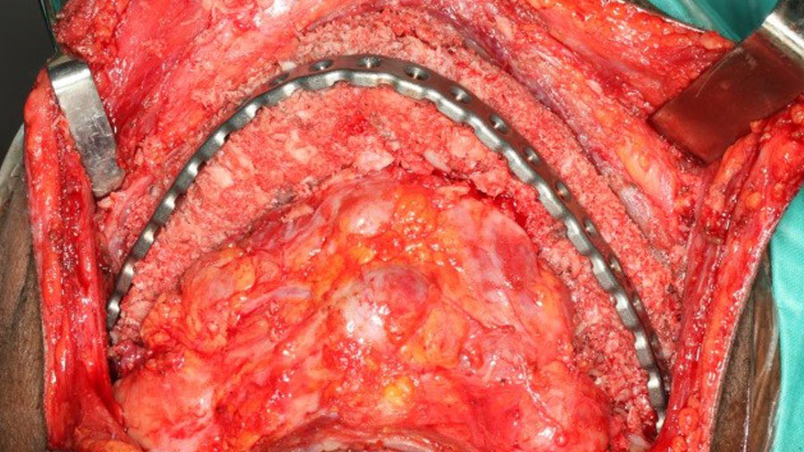 The particulate iliac crest bone graft: An overlooked alternative for mandibular reconstruction