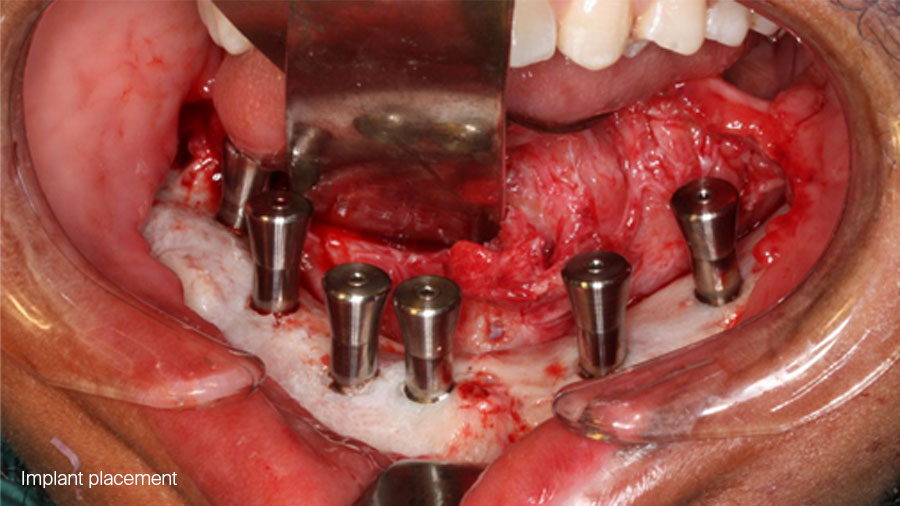 The particulate iliac crest bone graft: An overlooked alternative for mandibular reconstruction