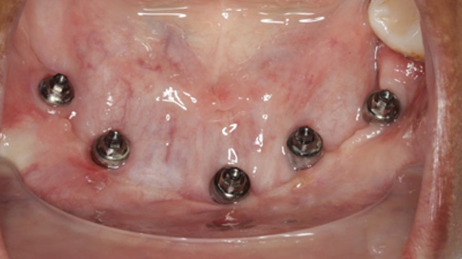 The particulate iliac crest bone graft: An overlooked alternative for mandibular reconstruction