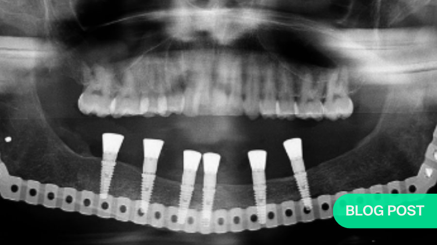 The particulate iliac crest bone graft: An overlooked alternative for mandibular reconstruction