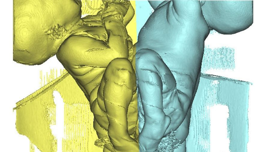 Twin toddlers on their way to healthy, active lives, thanks to two AO CMF surgeons on multidisciplinary team