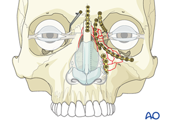 AO CMF Midface trauma revised content AO CMF Midface trauma revised content