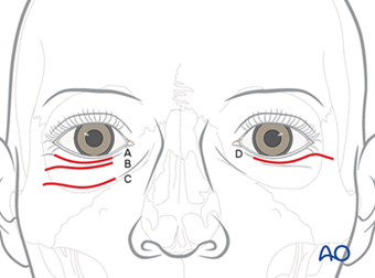AO CMF Midface trauma revised content AO CMF Midface trauma revised content