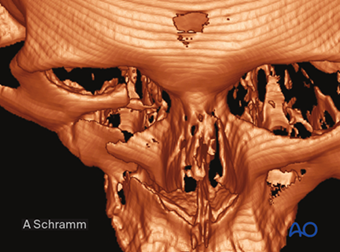 AO CMF Midface trauma revised content AO CMF Midface trauma revised content