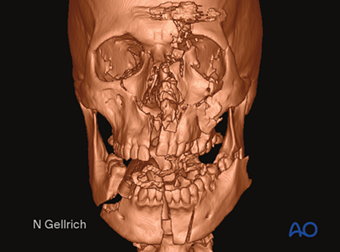 AO CMF Midface trauma revised content AO CMF Midface trauma revised content