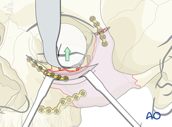 AO CMF Midface trauma revised content AO CMF Midface trauma revised content