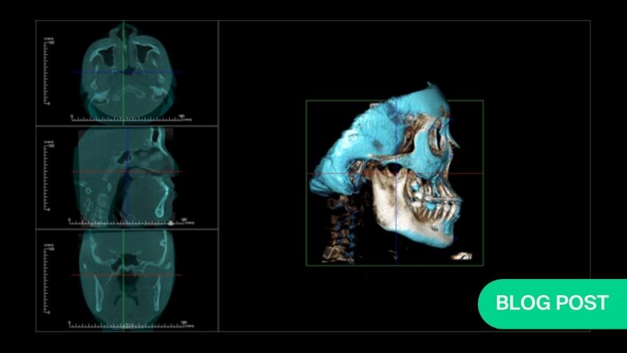 Addressing Maxillary Hypoplasia During Growth