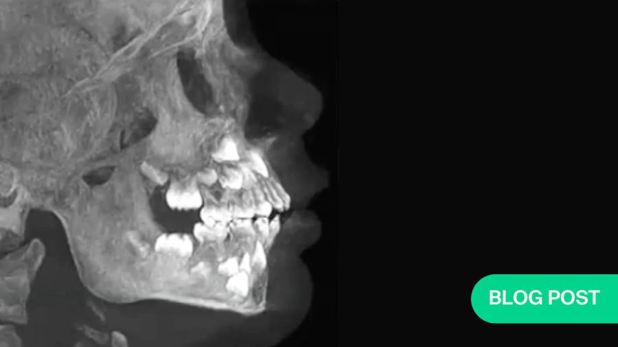 Pediatric TMJ reconstructions