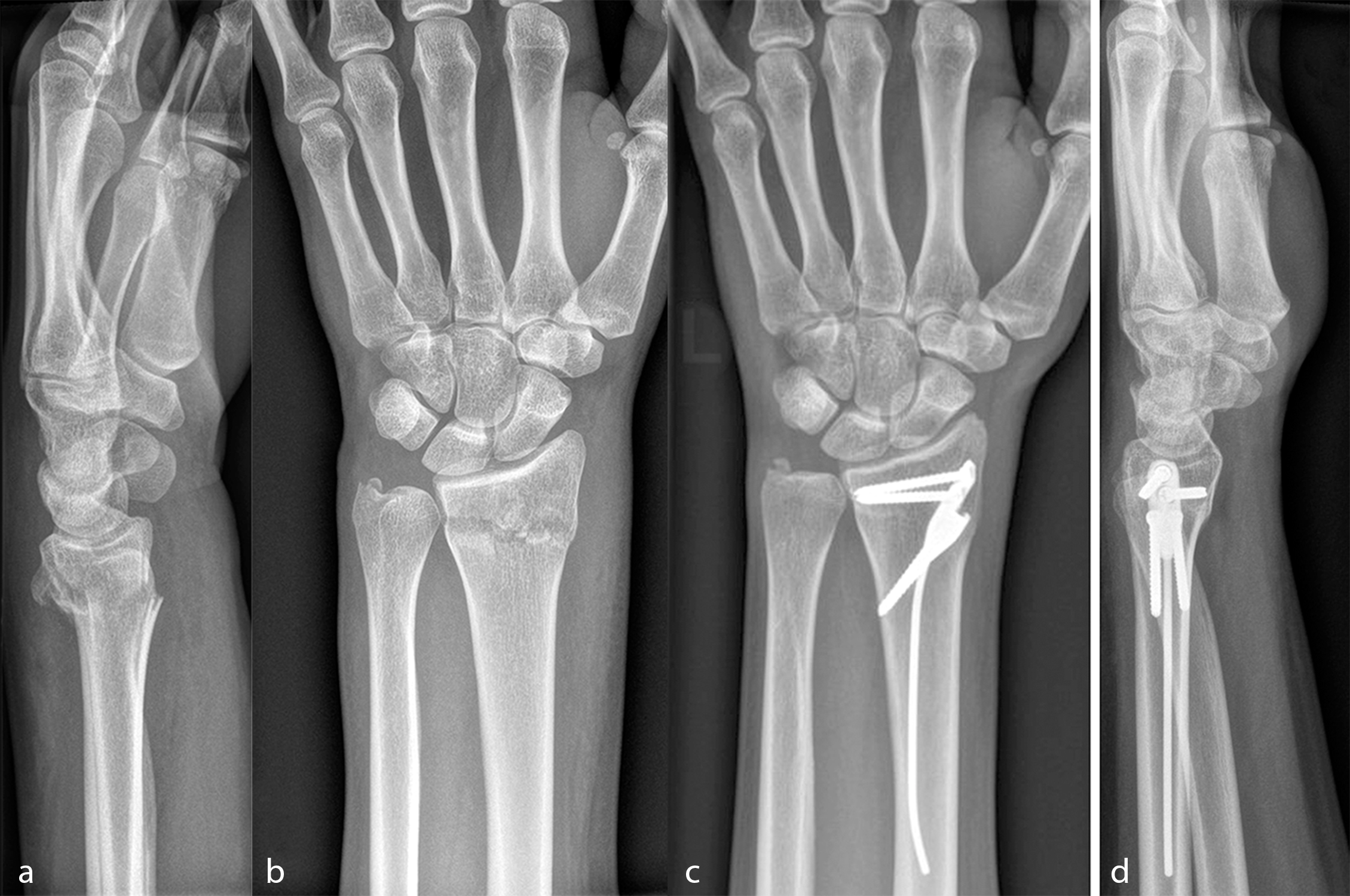 X rays of fracture to distal radius