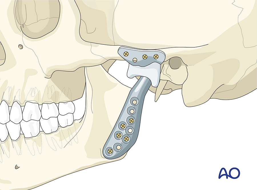 TMJ prosthesis