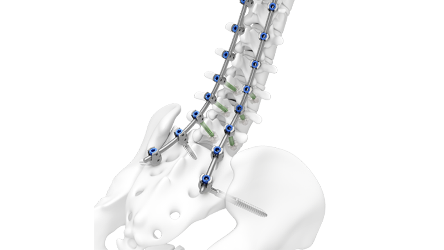 TriALTIS™ Spine System