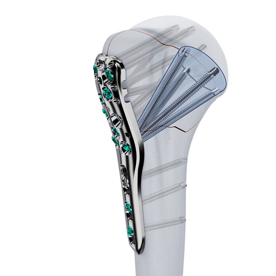The VOLT Proximal Humerus Plate (short) with new VOLT Locking Technology