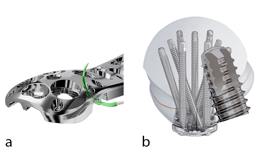 Fig 2 (a) Redesigned suture holes; (b) New VOLTTM 3.5 mm Locking Screws with atraumatic screw tip