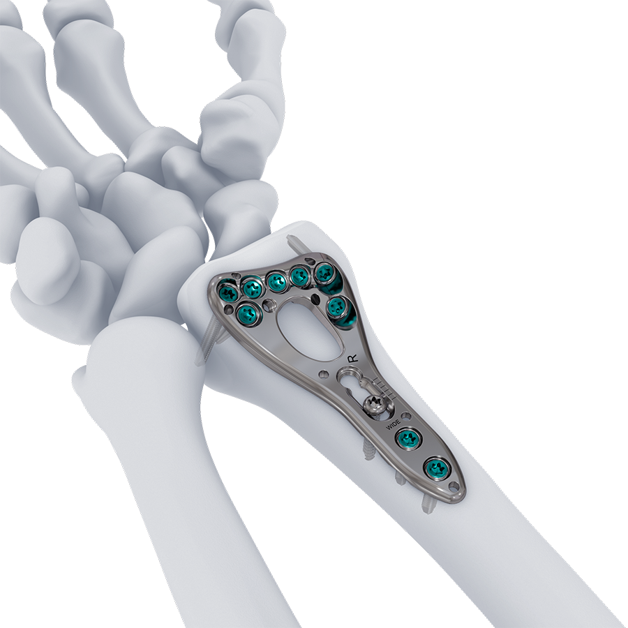 VOLT Wrist System Two-Column Distal Radius Plate