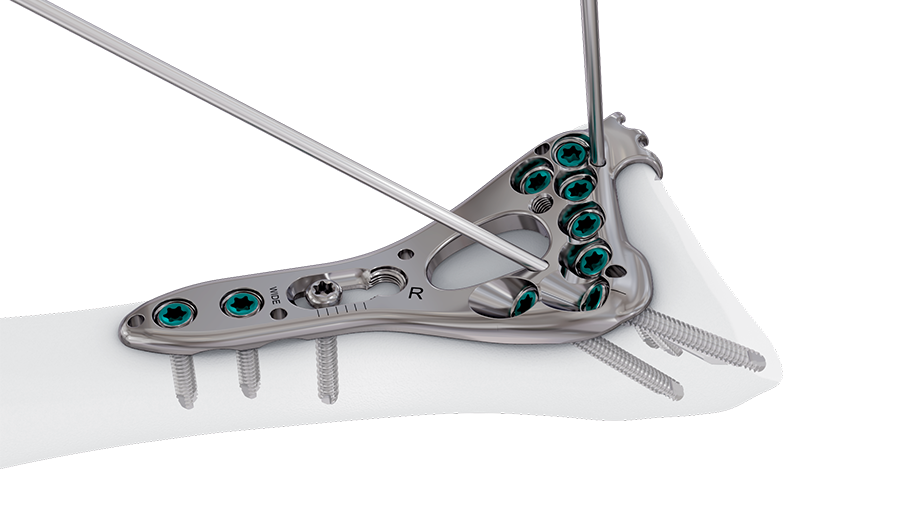 VOLT Wrist System Two-Column Distal Radius Rim Plate