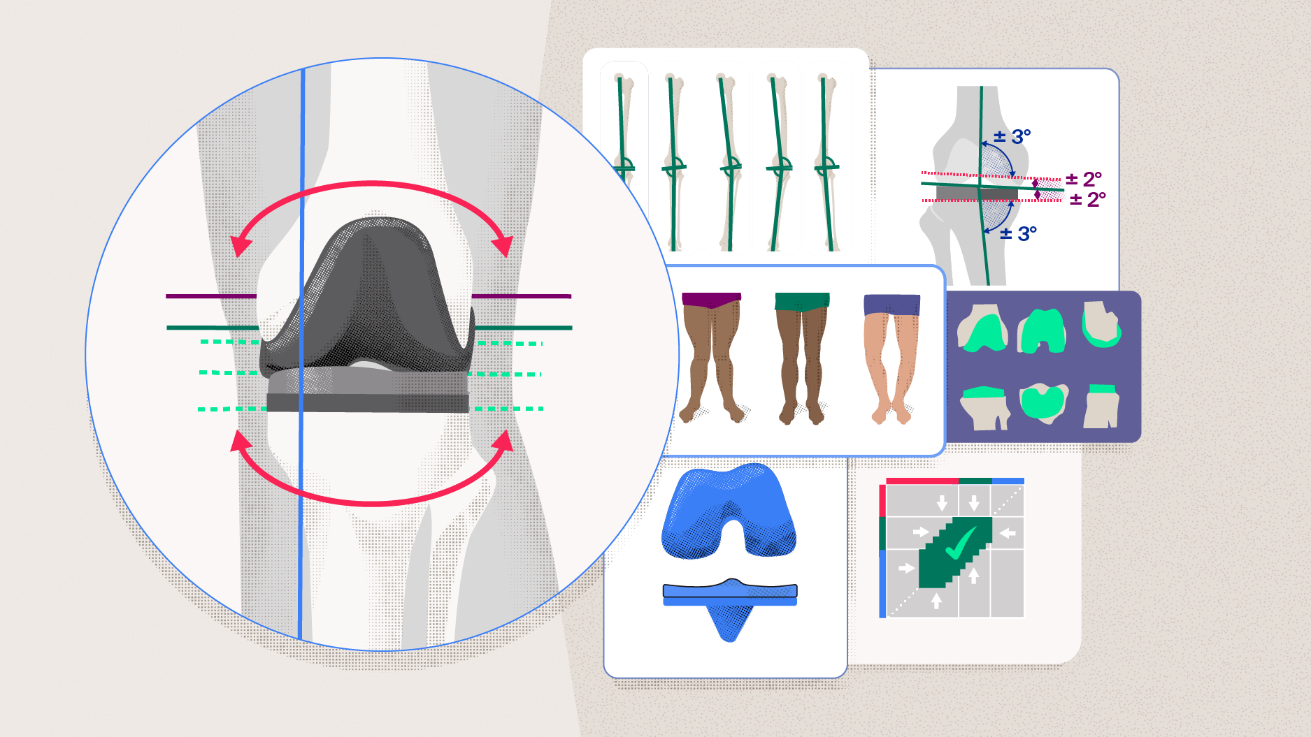 New scientific publication on alignment strategies in total knee arthroplasty