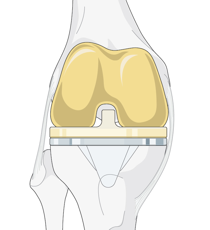 Unicompartmental knee arthroplasty versus high tibial osteotomy