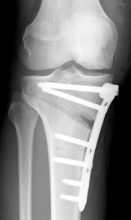 Unicompartmental knee arthroplasty versus high tibial osteotomy