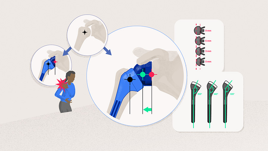 Adopting lateralization techniques in reverse shoulder arthroplasty