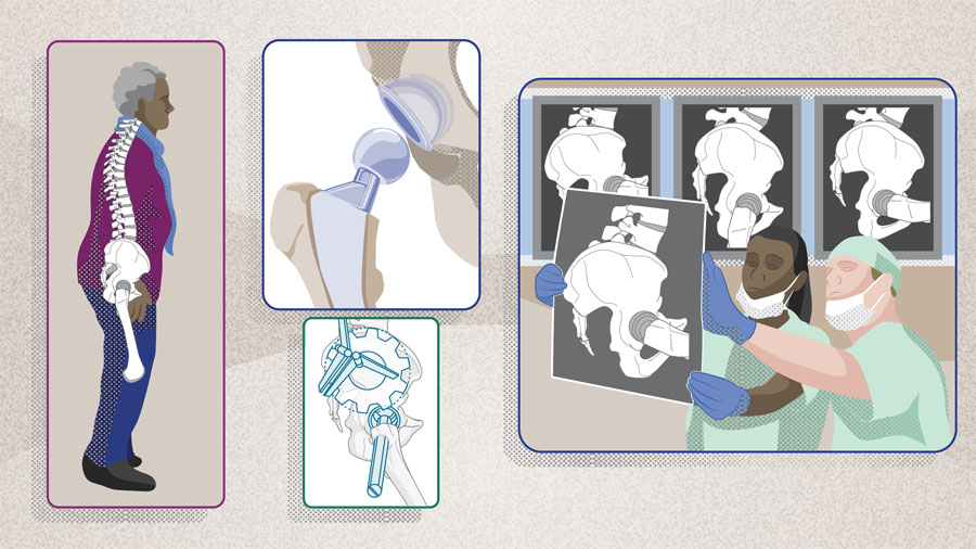 The spinopelvic relationship in total hip arthroplasty