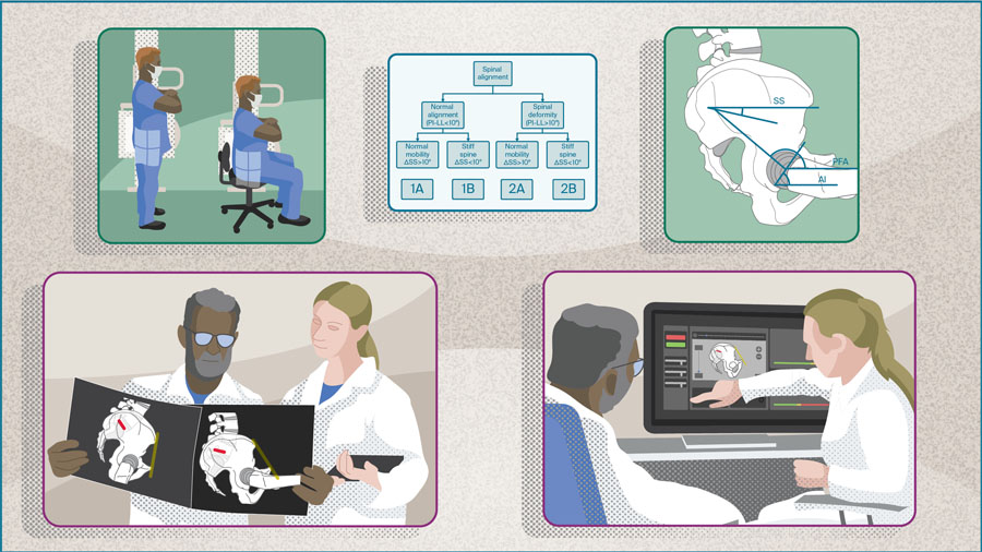 The spinopelvic relationship in total hip arthroplasty