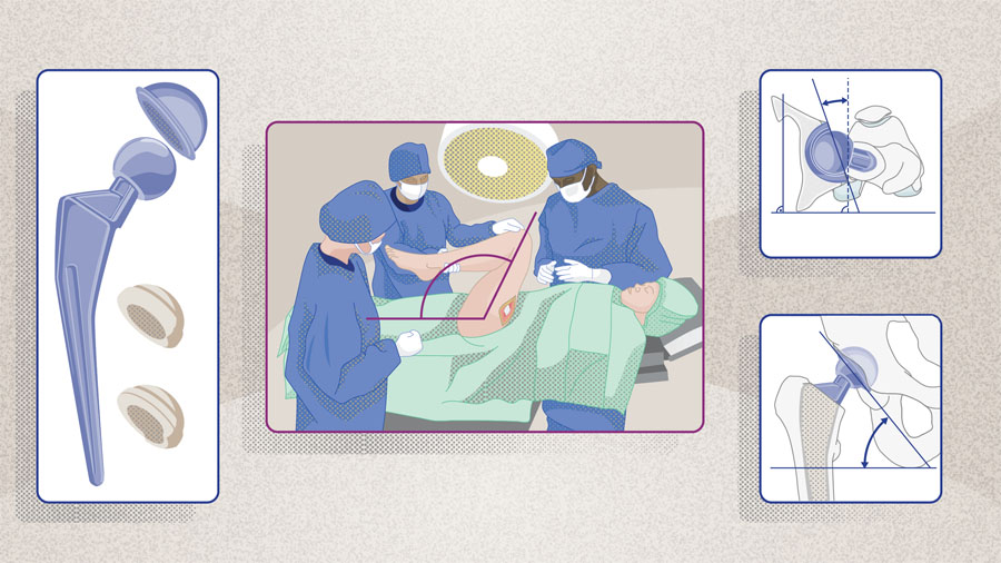 The spinopelvic relationship in total hip arthroplasty