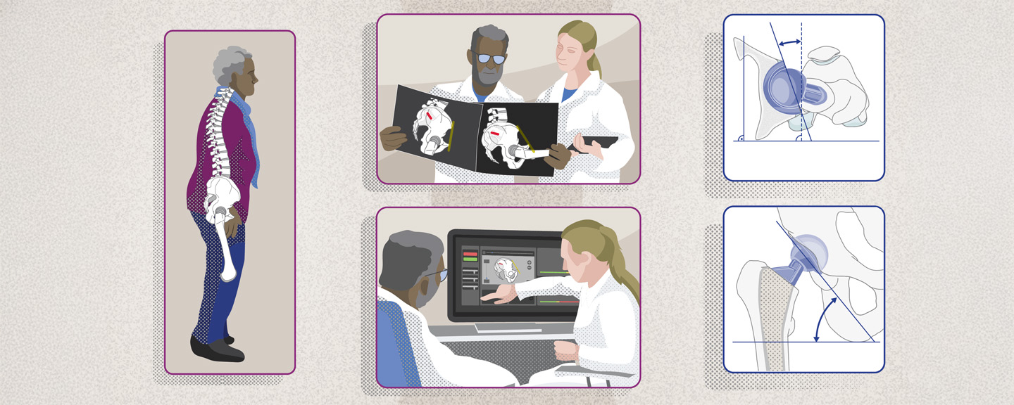 AO Recon Surgucal Insights: The spinopelvic relationship in total hip arthroplasty