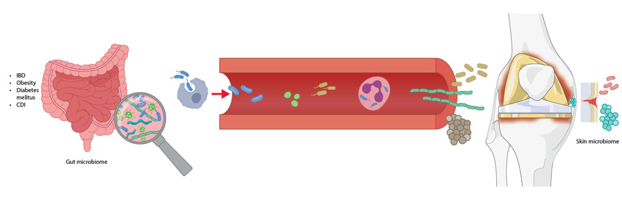 The gut, skin, and joint microbiota have been identified as possible sources of bacteria in the development of PJ