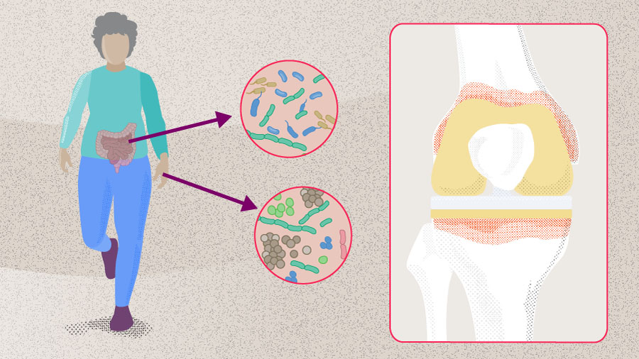 Update on periprosthetic joint infection