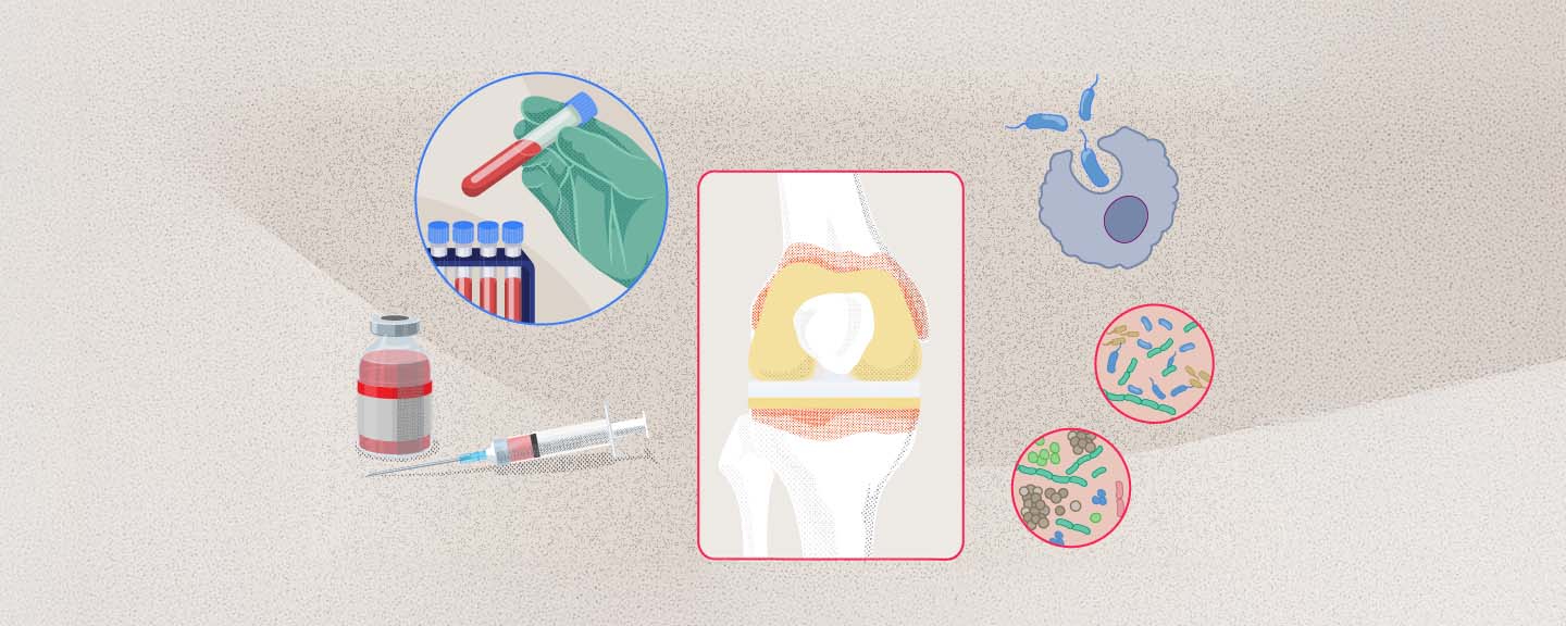 Surgical Insights - Update on periprosthetic joint infection