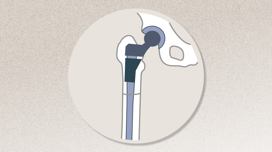 AO Recon Curricula_Complex Total - Hip