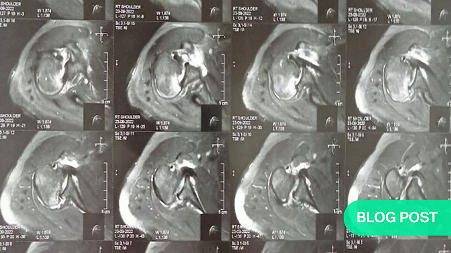 Easy to miss, challenging to fix: neglected locked posterior shoulder dislocation