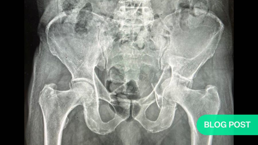 Operative vs non-operative management of geriatric acetabular fractures: persisting clinical challenges in decision-making and outcome reporting