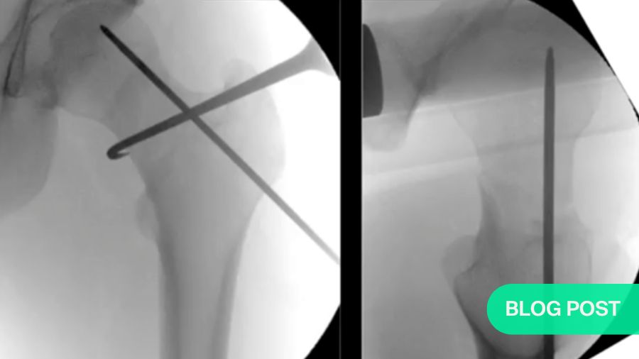 Proximal femoral fractures—acute management and indications for hip replacement