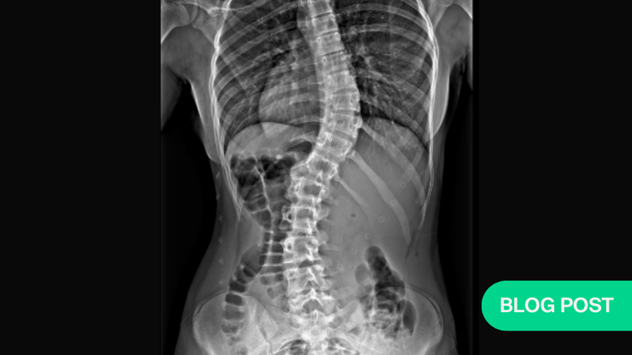 Blog Scoliosis