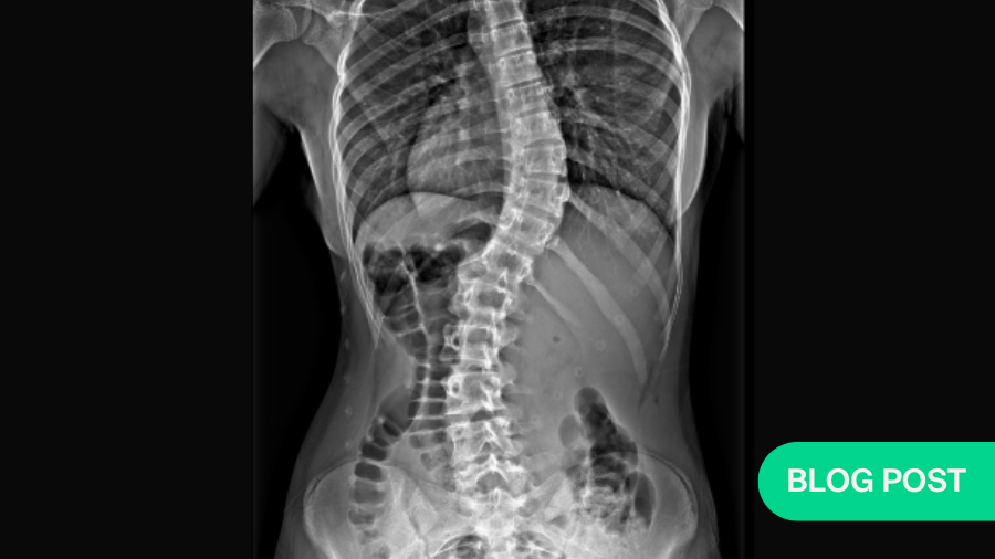 How useful are scoliosis exercises for adolescent patients with idiopathic scoliosis?