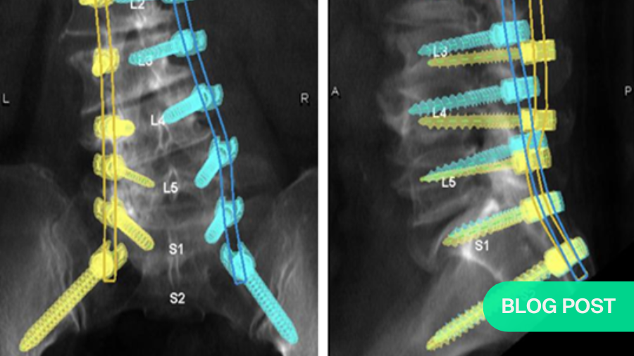 Surgical robots—into a new era for spine surgery instrumentation
