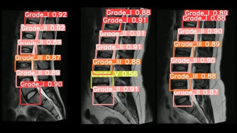 Automatic Machine Learning detection and classification based on Pfirrmann grading for lumbar disc degeneration.