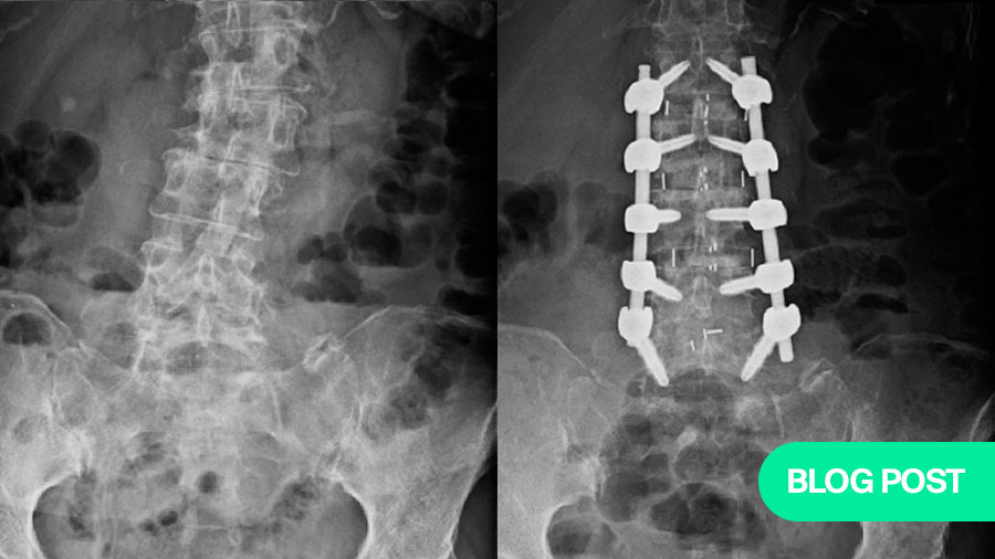 Pre-psoas approach—a true game changer in Adult Spinal Deformities