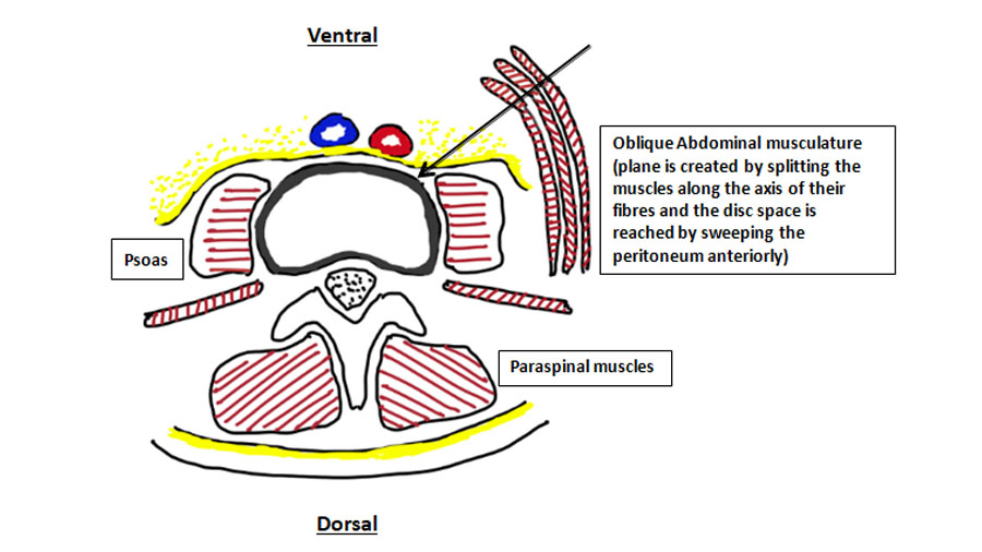 Pre-Psoas Approach Diagram