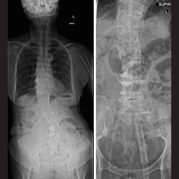 Adult Spinal Deformity (ASD) Radiograph