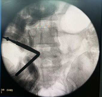 Unilateral Biportal Endoscopy (UBE): 10 essentials for starting your endoscopic journey