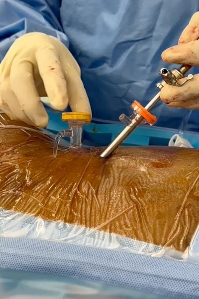 Unilateral Biportal Endoscopy (UBE): 10 essentials for starting your endoscopic journey