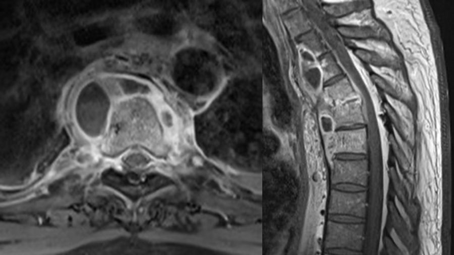 The artful dodger: capturing elusive spinal tuberculosis aka Potts disease