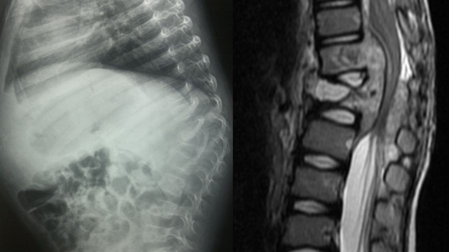 The artful dodger: capturing elusive spinal tuberculosis aka Potts disease