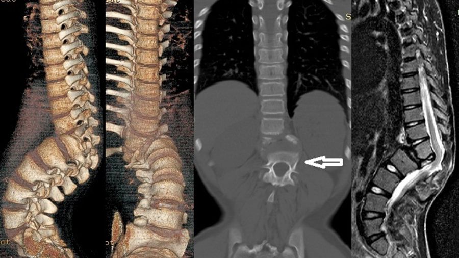 The artful dodger: capturing elusive spinal tuberculosis aka Potts disease